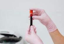 Novo exame ajuda no diagnóstico precoce do câncer de pâncreas exame de sangue