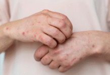Sintomas e causas da dermatite atópica nos dias de frio Sintomas e causas da dermatite atópica nos dias de frio