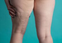 Junho Roxo alerta para sinais do lipedema lipedema