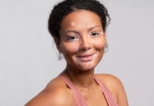 uma relação que exige atenção mulher com vitiligo