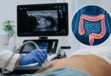 Ultrassonografia intestinal amplia monitoramento da Doença Inflamatória Intestinal ultrassonografia intestinal