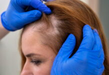 Cabelo afinando pode indicar alopecia androgenética Mulher observando o cabelo no espelho